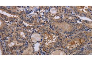 Immunohistochemistry of paraffin-embedded Human thyroid cancer using FADS1 Polyclonal Antibody at dilution of 1:60 (FADS1 Antikörper)