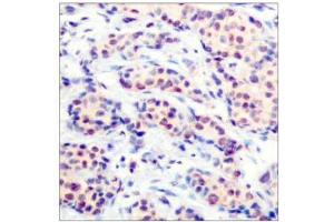 Immunohistochemical analysis of paraffin-embedded human breast carcinoma tissue using JunD (Ab-255) antibody (E021028). (JunD Antikörper)