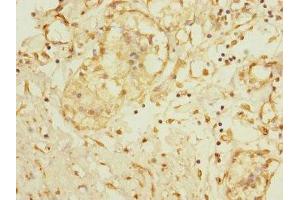 Immunohistochemistry of paraffin-embedded human breast cancer using ABIN7150051 at dilution of 1:100