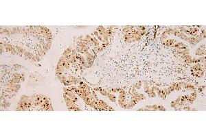 Immunohistochemistry of paraffin-embedded Human liver cancer tissue using RFX6 Polyclonal Antibody at dilution of 1:50(x200) (RFX6 Antikörper)