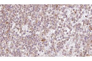 ABIN6273200 at 1/100 staining Human lymph cancer tissue by IHC-P. (BBS10 Antikörper  (Internal Region))