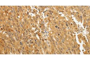 Immunohistochemistry of paraffin-embedded Human ovarian cancer using AKR1A1 Polyclonal Antibody at dilution of 1:30 (AKR1A1 Antikörper)