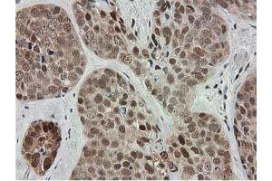 Immunohistochemical staining of paraffin-embedded Adenocarcinoma of Human breast tissue using anti-SMS mouse monoclonal antibody. (SMS Antikörper)