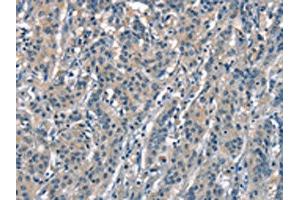 The image on the left is immunohistochemistry of paraffin-embedded Human gastric cancer tissue using ABIN7189631(ACPT Antibody) at dilution 1/30, on the right is treated with synthetic peptide. (Testicular Acid Phosphatase (ACP4) Antikörper)