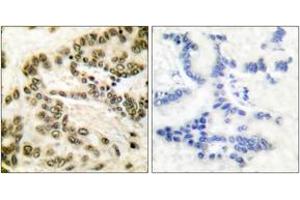 Immunohistochemistry analysis of paraffin-embedded human lung carcinoma tissue, using CREB (Ab-142) Antibody. (CREB1 Antikörper  (AA 111-160))