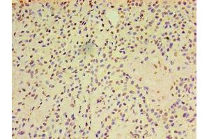 Immunohistochemistry of paraffin-embedded human breast cancer using ABIN7143455 at dilution of 1:100 (ARF6 Antikörper  (AA 1-175))