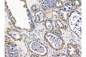 ABIN7093776 and ABIN7097817 at 1/100 staining human ovarian cancer by IHC-P. (HMOX1 Antikörper)