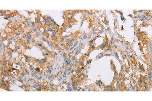 Immunohistochemistry of paraffin-embedded Human thyroid cancer tissue using ACTR2 Polyclonal Antibody at dilution 1:40 (ACTR2 Antikörper)
