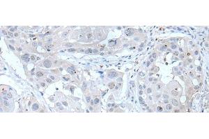 Immunohistochemistry of paraffin-embedded Human esophagus cancer tissue using ANGPTL6 Polyclonal Antibody at dilution of 1:55(x200) (ANGPTL6 Antikörper)