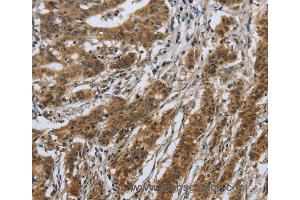 Immunohistochemistry of Human gastric cancer using IL5RA Polyclonal Antibody at dilution of 1:40 (IL5RA Antikörper)
