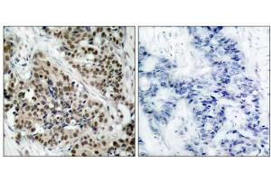 Immunohistochemical analysis of paraffin- embedded human breast carcinoma tissue using FKHR (phospho-Ser256) antibody (E011115). (FOXO1 Antikörper  (pSer256))