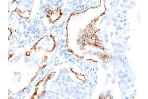 Formalin-fixed, paraffin-embedded human Lung SCC stained with Cytokeratin 7 Mouse Monoclonal Antibody (K72. (Cytokeratin 7 Antikörper)