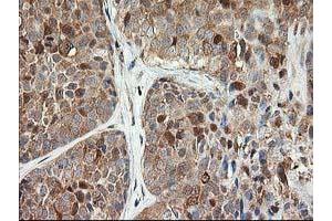 Immunohistochemical staining of paraffin-embedded Adenocarcinoma of Human breast tissue using anti-LSM1 mouse monoclonal antibody. (LSM1 Antikörper)