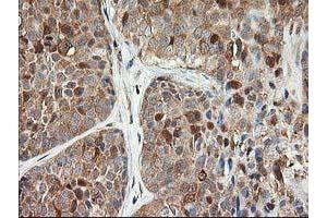 Immunohistochemical staining of paraffin-embedded Adenocarcinoma of Human breast tissue using anti-LSM1 mouse monoclonal antibody. (LSM1 Antikörper)