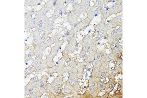 Immunohistochemistry of paraffin-embedded Human liver cancer using CD276/B7-H3 antibody (ABIN7266182) at dilution of 1:100 (40x lens). (CD276 Antikörper  (AA 100-200))