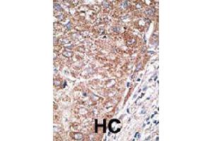 Formalin-fixed and paraffin-embedded human hepatocellular carcinoma tissue reacted with NEUROD1 polyclonal antibody  , which was peroxidase-conjugated to the secondary antibody, followed by DAB staining. (NEUROD1 Antikörper  (N-Term))
