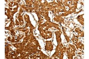 The image on the left is immunohistochemistry of paraffin-embedded Human lung cancer tissue using ABIN7128859(CDH23 Antibody) at dilution 1/80, on the right is treated with fusion protein. (CDH23 Antikörper)