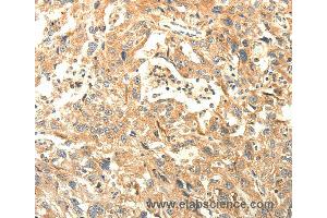 Immunohistochemistry of Human lung cancer using AGRN Polyclonal Antibody at dilution of 1:30 (AGRN Antikörper)