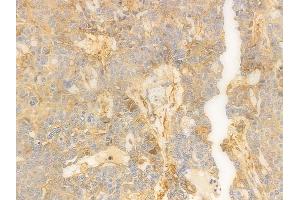 ABIN6259956 and ABIN6276843 at 1/100 staining human ovarian carcinoma by IHC-P. (Annexin V Antikörper  (C-Term))