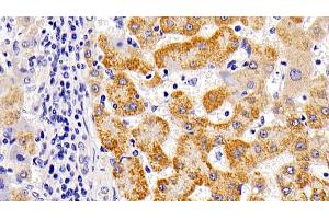 Detection of LAMP1 in Human liver cirrhosis Tissue using Polyclonal Antibody to Lysosomal Associated Membrane Protein 1 (LAMP1) (LAMP1 Antikörper  (AA 49-297))