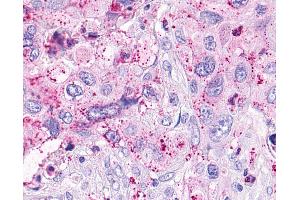 Anti-OXER1 antibody IHC of human Pancreas, Carcinoma. (OXER1 Antikörper  (C-Term))