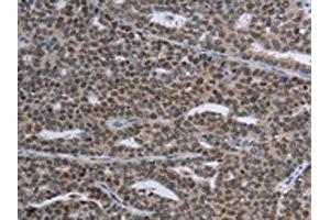 The image on the left is immunohistochemistry of paraffin-embedded Human ovarian cancer tissue using ABIN7191353(MAGEC1 Antibody) at dilution 1/30, on the right is treated with synthetic peptide.