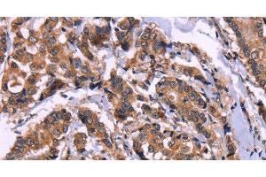 Immunohistochemistry of paraffin-embedded Human breast cancer using AMIGO2 Polyclonal Antibody at dilution of 1:50 (AMIGO2 Antikörper)