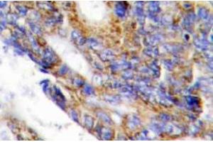 Immunohistochemistry (IHC) analyzes of COL1A2 antibody in paraffin-embedded human colon carcinoma tissue. (COL1A2 Antikörper  (Chain alpha 2))