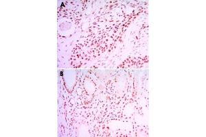 Immunohistochemical analysis of paraffin-embedded human lung cancer tissue (A) and kidney cancer tissue (B) using SIRT1 monoclonal antobody, clone 1F3  with DAB staining.