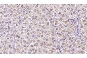 ABIN6277784 at 1/100 staining Human melanoma tissue by IHC-P. (CCL2 Antikörper  (Internal Region))