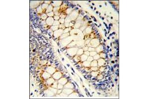 Formalin-Fixed, Paraffin-Embedded Human colon carcinoma reacted with SFRS1 Antibody (C-term), which was Peroxidase-conjugated to the secondary antibody, followed by DAB staining. (SRSF1 Antikörper  (C-Term))