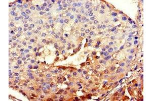 Immunohistochemistry of paraffin-embedded human breast cancer using ABIN7147837 at dilution of 1:100 (BHLHE40 Antikörper  (AA 184-302))