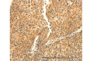 Immunohistochemistry of Human liver cancer using AARS2 Polyclonal Antibody at dilution of 1:80 (AARS2 Antikörper)