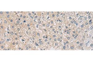 Immunohistochemistry of paraffin-embedded Human liver cancer tissue using WFDC3 Polyclonal Antibody at dilution of 1:40(x200) (WFDC3 Antikörper)