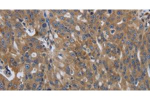 Immunohistochemistry of paraffin-embedded Human ovarian cancer using SOCS1 Polyclonal Antibody at dilution of 1:90 (SOCS1 Antikörper)