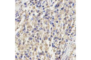 Immunohistochemistry of paraffin-embedded human lung cancer using KLRD1 antibody at dilution of 1:200 (x400 lens)