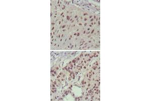 Immunohistochemical analysis of paraffin-embedded human lung cancer (upper) and cervical carcinoma (bottom) , showing nuclear localization using ISL1 monoclonal antibody, clone 1H9  with DAB staining. (ISL1 Antikörper)