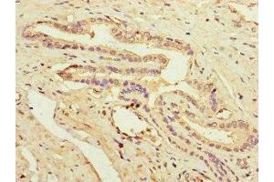 Immunohistochemistry of paraffin-embedded human prostate cancer using ABIN7162936 at dilution of 1:100 (Peroxiredoxin 2 Antikörper  (AA 2-65))