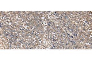 Immunohistochemistry of paraffin-embedded Human liver cancer tissue using ZFP36 Polyclonal Antibody at dilution of 1:40(x200) (ZFP36 Antikörper)