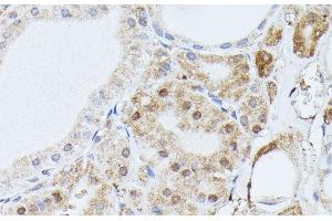 Immunohistochemistry of paraffin-embedded Human thyroid cancer using PPP2R5D Polyclonal Antibody at dilution of 1:100 (40x lens). (PPP2R5D Antikörper)