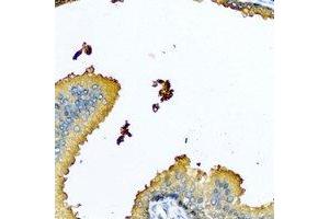 Immunohistochemical analysis of Nyctalopin staining in human prostate formalin fixed paraffin embedded tissue section. (Nyctalopin Antikörper)
