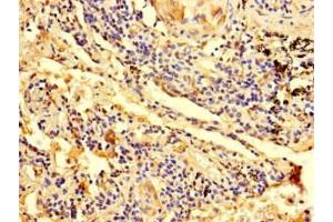 Immunohistochemistry of paraffin-embedded human lung cancer using ABIN7176377 at dilution of 1:100 (ZNF559 Antikörper  (AA 1-300))