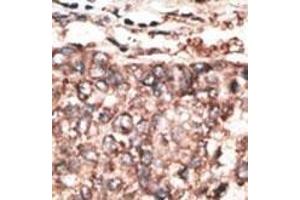 Formalin-fixed and paraffin-embedded human cancer tissue reacted with the primary antibody, which was peroxidase-conjugated to the secondary antibody, followed by AEC staining.