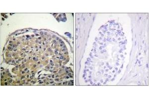 Immunohistochemistry analysis of paraffin-embedded human breast carcinoma, using CD227/Mucin 1 (Phospho-Tyr1243) Antibody. (MUC1 Antikörper  (pTyr1243))