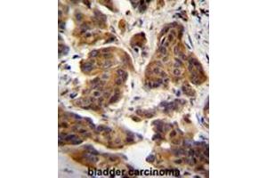C4orf21 Antibody (N-term) immunohistochemistry analysis in formalin fixed and paraffin embedded human bladder carcinoma followed by peroxidase conjugation of the secondary antibody and DAB staining. (ZGRF1 Antikörper  (N-Term))
