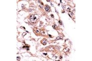 Formalin-fixed and paraffin-embedded human cancer tissue reacted with the primary antibody, which was peroxidase-conjugated to the secondary antibody, followed by AEC staining. (PPP3CC Antikörper  (C-Term))