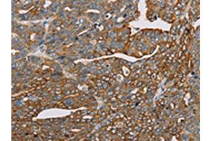 The image on the left is immunohistochemistry of paraffin-embedded Human cervical cancer tissue using ABIN7130290(MTFP1 Antibody) at dilution 1/30, on the right is treated with fusion protein.