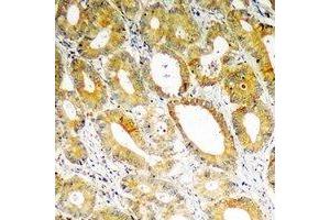 Immunohistochemical analysis of PDK4 staining in human colon cancer formalin fixed paraffin embedded tissue section. (PDK4 Antikörper)