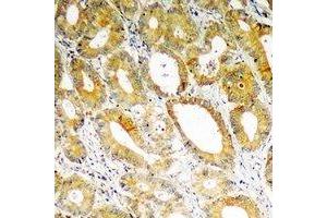 Immunohistochemical analysis of PDK4 staining in human colon cancer formalin fixed paraffin embedded tissue section.