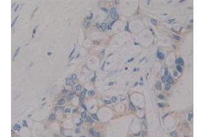 Detection of IGF1 in Human Bile duct cancer Tissue using Polyclonal Antibody to Insulin Like Growth Factor 1 (IGF1) (IGF1 Antikörper  (AA 49-118))